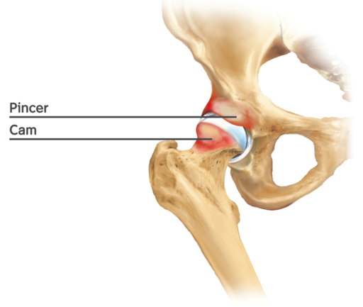 Vulvar Pain and Femoroacetabular Impingement